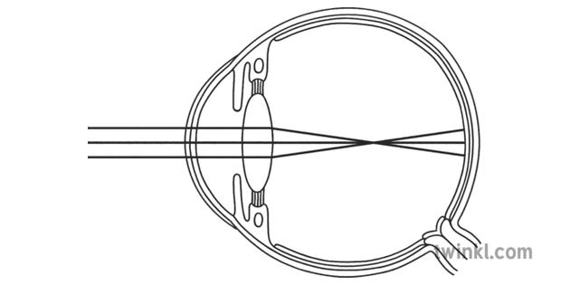 Structure of a Short Sighted Eye Science Biology Diagram Beyond Black and