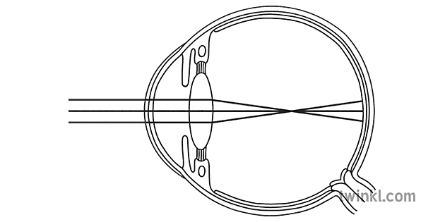 Structure of a Short Sighted Eye Science Biology Diagram Beyond Black and