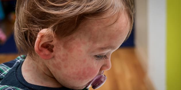 What to do if you think your child has measles and when to keep